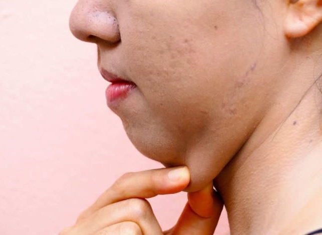 How to Get Rid of Double Chin? Detailed Information You Need