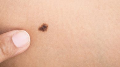 Skin Cancer: Symptoms and Warning Signs
