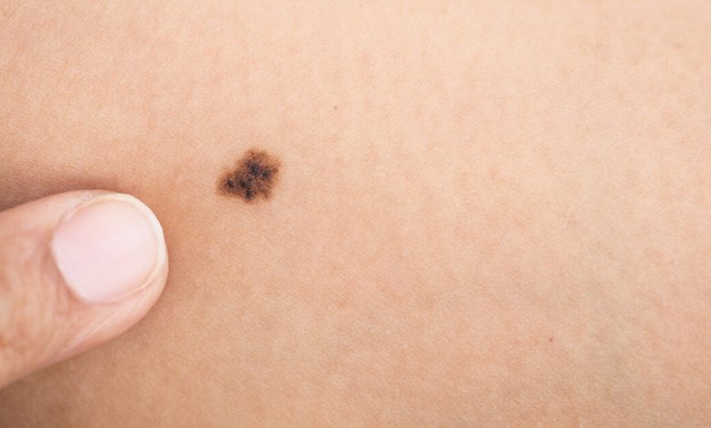 Skin Cancer: Symptoms and Warning Signs